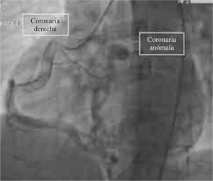 Coronariografía. Origen aórtico de la coronaria derecha con llenado retrógrado de la coronaria izquierda y drenaje del tronco de la misma hacia la arteria pulmonar.
