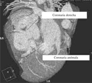 Angiotomografía coronaria. Se demuestra el origen de cada una de las arterias coronarias.