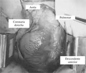 Imagen del campo quirúrgico inicial. Se ilustra el diámetro y trayecto de las arterias.
