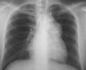 Radiografía de tórax ilustrando la condición actual del paciente.