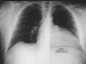 La radiografía de tórax muestra la existencia de una cardiomegalia y un marcado desplazamiento a la izquierda de la silueta cardíaca. Se puede observar una triple convexidad en el borde izquierdo cardíaco, que es debida a la prominencia del arco aórtico, la arteria pulmonar y un ventrículo izquierdo.
