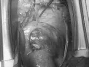 Imagen del campo quirúrgico en la que se observa el defecto y la adherencia del pericardio a la parte más inferior del diafragma, lo que causa la constricción de los ventrículos.