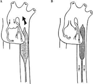 Colocación correcta del BIACP en aorta descendente. A: inflado durante la diástole con válvula aórtica cerrada. B: desinflado durante la sístole. Válvula aórtica abierta.