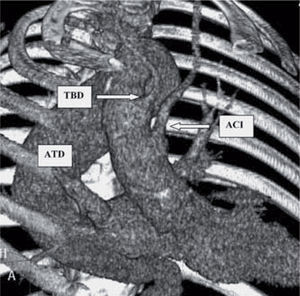 Tomografía axial computarizada tridimensional que muestra una dilatación aneurismática del tercio distal del arco aórtico derecho y de la totalidad de la ATD; esta última está situada a la derecha de la columna vertebral y presenta una elongación hacia la izquierda en el istmo aórtico y distalmente a nivel del hiato diafragmático. ACI: arteria carótida izquierda; TBD: tronco braquiocefálico derecho; ATD: aorta torácica descendente.