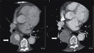 Controles tomográficos postoperatorios a los 6 meses (A) y al año (B), que evidencian una reducción progresiva del flujo sanguíneo en el saco aneurismático.