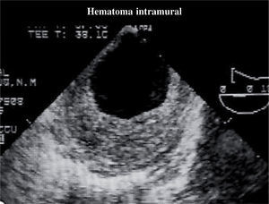 Imagen típica en ETE de un hematoma intramural.