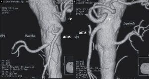 A: imagen de reconstrucción multiplanar de la aorta abdominal a nivel de las arterias renales. Se observa grave calcificación de la aorta abdominal y ostia de las arterias renales y de la arteria esplénica, así como estenosis aguda del origen de la arteria renal derecha. B: imagen de VR de la aorta a nivel de las arterias renales, donde se observa grave calcificación de la aorta y estenosis aguda de la arteria renal derecha.