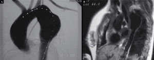 A: imagen de VR de un caso de disección de aorta tipo B de Stanford tratada con endoprótesis cubierta en la luz verdadera desde el cayado aórtico hasta la aorta descendente proximal. Existe un relleno retrógrado de la luz falsa (LF). B: imagen en VR de la aorta abdominal, donde se aprecia con detalle la salida de los troncos viscerales y la arteria renal izquierda.