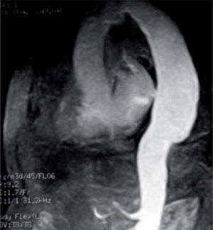 Angiorresonancia dinámica de la aorta torácica con gadolinio ev. (técnica de sangre blanca): se observa un aneurisma extenso de aorta descendente.
