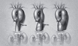 Classification of descending thoracic aortic aneurysms