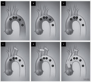 A: distribution of landing zones for TEVAR. Zone 0: repair involving the innominate artery. Zone 1: involving the left carotid artery. Zone 2: involving the left subclavian artery. Zone 3: involving the proximal third of the descending thoracic aorta. Zone 4: involving the distal two thirds of the descending thoraci aorta. B and C: placement of a device in zone 3 or 4 without any revascularization. D: coverage of the left subclavian artery with a left carotid subclavian bypass. E: coverage of the left carotid and subclavian arteries with a carotid-carotid and carotid subclavian bypass. F: complete arch coverage with ascending aorta to innominate and left carotid bypass as well as a left carotid subclavian bypass.