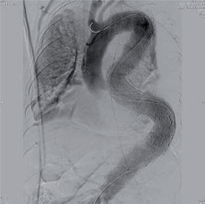 A completion angiogram from a patient with an extent C aneurysm who suffered a perioperative left hemispheric stroke. A total of 5 devices were placed through an extremely tortuous anatomy.
