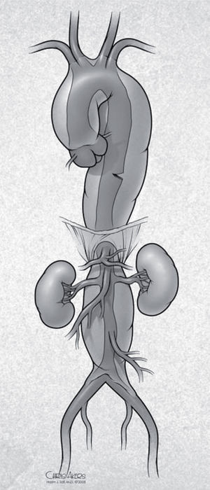 Retrograde dissection is defined as an intimal tear distal to the transverse arch with retrograde extension into the ascending aorta.