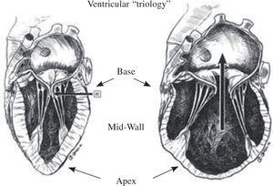 Fiber orientation in dilated spherical ventricle (above), whereby the “coils within coils” fiber orientation is more transverse: this configuration impairs function. Anticipated changes in fiber orientation following surgical ventricular restoration are shown below. A spherical form may persist by placing the patch in a flatter (lower left), rather than oblique direction (lower right). The treatment of “form versus disease” is accomplished by rebuilding this normal oblique configuration of the cardiac helix, and the solid line (lower right) reflects the oblique angulation of the surgical closure that rebuilds the natural ellipse. This left ventricular oblique reconfiguration may be accomplished with sutures or a patch, but the upper placement site within the septum just below the aortic valve annulus often contains normal muscle.