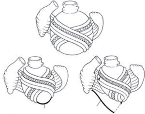 Changes in “ventricular trilogy” whereby dilation varies ventricular geometry by making the apex circular, widening of the mid-wall that joins with the circular apex to cause tethering on the mitral valve apparatus, and widening of the base, so that the point of coaptation of mitral leaflets is adversely altered.