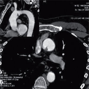 Dos imágenes de angio-TC en cortes sagital (pequeña) y transversal (grande) que muestran el defecto de repleción intraluminal por la masa tumoral sin que existan signos de extensión locorregional mediastínica.