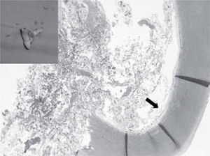 Visión macroscópica de la neoplasia mucoide intraluminal. Visión microscópica con tinción de hematoxilina-eosina de una sección transversal de la pared aórtica que contiene la proliferación neoplásica subintimal (flecha negra) y el lumen ocupado por material fibrinohemorrágico y mixoide.