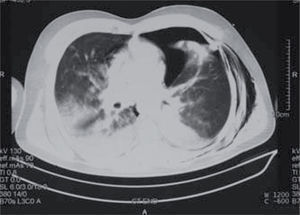 Radiografía de tórax del primer paciente, compatible con edema agudo de pulmón.