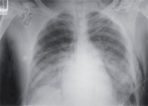TC torácica del primer paciente, que muestra neumotórax bilateral y contusiones pulmonares.
