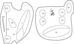 Descripción esquemática de los obstáculos anatómicos y barrera funcional de las aurículas. En esquema están representadas ambas aurículas. VCS: vena cava superior; VCI: vena cava inferior; SC: seno coronario; FO: fosa oval; T: anillo tricúspide; M: anillo mitral; VP: vena pulmonar; CT: cresta terminal (barrera funcional) representada con la línea ; CQ: cicatriz quirúrgica representada con la línea XX; F: área de fibrosis representada con zona sombreada en la cara posterior de la AI.