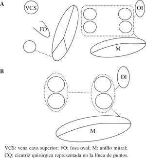 Esquema del patrón de lesiones del mini-Maze. Dos esquemas de mini-Maze con diferentes formas de aislar las venas pulmonares. a: exclusión conjunta de todas las venas pulmonares (box-lesion). B: aislamiento circunferencial (selectivo) de las venas pulmonares con una lesión que conecta ambos lados. Abreviaturas similares a las empleadas en anteriores figuras. VCS: vena cava superior; FO: fosa oval; M: anillo mitral; CQ: cicatriz quirúrgica representada en la línea de puntos.