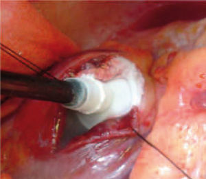 Crioablación de foco ventricular intramiocárdico a través de una ventriculotomía.