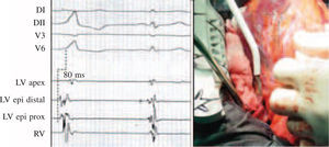 Crioablación epicárdica de taquicardia ventricular. Cartografía de activación y crioablación epicárdica de extrasistolia ventricular idiopática de alta densidad con origen en las proximidades del tronco de la coronaria izquierda.