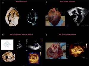 Planos anatómicos y su correlación con el ecocardiograma. A: plano frontal, vista anatómica y en eco plano apical cuatro cámaras visto desde el ápex del VI. B: plano frontal anatómico y vista frontal de un corazón, imagen anatómica de cuatro cámaras invertida. C: eje corto anatómico visto desde el ápex recortando el VI, en ETT vista de la VM eje corto desde el ápex de VI, vista 3D en una sola imagen desde el ápex visualizamos VM «vista cirujano» con aorta (AO) situada a las 12horas. D: eje corto anatómico de la VM, vista quirúrgica con AO situada a las 12horas, en imagen 3D vista similar velos mitrales y AO a las 12horas, se obtiene recortando ambas aurículas.