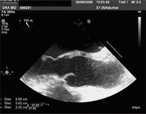 Medidas por ETE de la raíz aórtica y aorta ascendente.