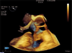 Imagen de ETT 3D de una válvula aórtica con una perforación en la valva no coronaria.