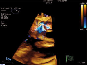Imagen de ETT 3D del mismo paciente de la figura anterior en la que se muestra el chorro de insuficiencia aórtica grave pasando a través de la perforación.