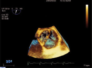 ETE 3D en tiempo real de una válvula aórtica trivalva con una pequeña masa en la valva no coronaria que correspondía a un fibroelastoma papilar.