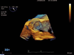 ETE 3D en tiempo real de una válvula aórtica trivalva con una masa redondeada en la valva coronaria izquierda que correspondía a un mixoma.