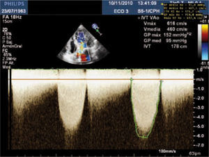 Gradiente transvalvular aórtico máximo y medio, y área valvular mediante la ecuación de continuidad.