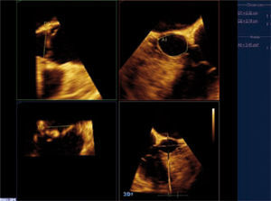 ETE 3D que muestra la medición del TSVI previa en dos planos ortogonales y el área del TSVI al mismo nivel.