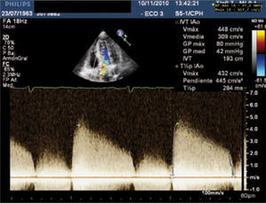 Imagen de ETT. Doppler continuo a través de la válvula aórtica que muestra el gradiente transvalvular y el tiempo de hemipresión del chorro de IAo.