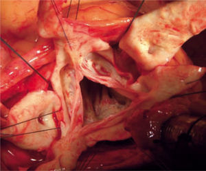Fotografía del campo quirúrgico. Aspecto de los velos de la válvula aórtica con un remanente de 2–3mm de pared de aorta que se utilizará para reimplantar la válvula en el conducto de dacrón.