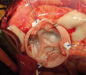 Fotografía del campo quirúrgico. Se observa la válvula aórtica reimplantada dentro de un conducto de dacrón de 34mm mediante sutura continua con polipropileno 4/0.