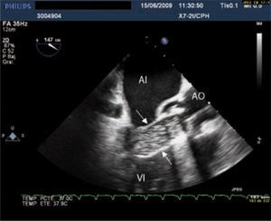 Monitorización del inflado de la prótesis mediante ETE. El balón que dilata la prótesis está señalado por las flechas blancas. AI: aurícula izquierda; VI: ventrículo izquierdo; AO: aorta.