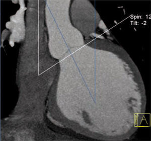 Proyección oblicuo coronal de la aorta ascendente con mediciones angulares del plano valvular y del eje tubular proximal.