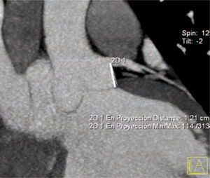 Medición en plano oblicuo coronal de la distancia valvular al orificio coronario izquierdo.