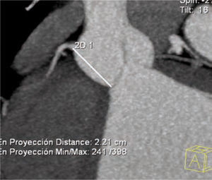 Medición en plano oblicuo coronal de la distancia valvular al orificio coronario derecho.