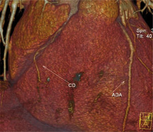 Representación tridimensional con el trayecto proximal de ambos vasos coronarios principales.
