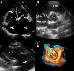 Planos ecocardiográficos para la valoración de la válvula tricúspide. a: apical cuatro cámaras. B: paraesternal eje corto a nivel de la aorta. C: paraesternal eje largo derecho. D: plano valvular en 3D. VD: ventrículo derecho; AD: aurícula derecha; VI: ventrículo izquierdo; AI: aurícula izquierda; TSVD: tracto de salida de ventrículo derecho; AO: aorta; A: valva anterior; S: valva septal; P: valva posterior.
