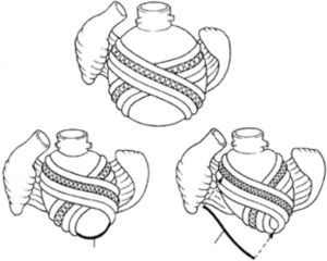 Bases de la hipótesis de Torrent Guasp para la aplicación del remodelado reverso del ventrículo.