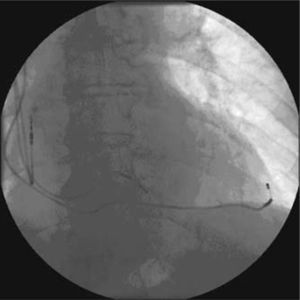 Imagen de sistema de MCP tricameral visto en escopia al final del implante, en proyección anteroposterior.