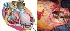 Panel superior. A: el molde está dentro del ventrículo (esquema). Panel inferior. B: la imagen del molde en quirófano. La sutura circular sigue la curvatura del molde para remodelar el ventrículo de forma elíptica.