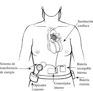 Componentes de un corazón artificial total AbioCor® (imagen proporcionada por Abiomed, Danvers, MA, USA).