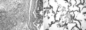 A: histología CMNMO + matriz de colágeno. La matriz con segmentos alineados a lo largo de la pared protege la escara del infarto. Hay incorporación de fibras desde la matriz al área del infarto. B: las células están agrupadas en grandes poblaciones entre las fibras de colágeno.