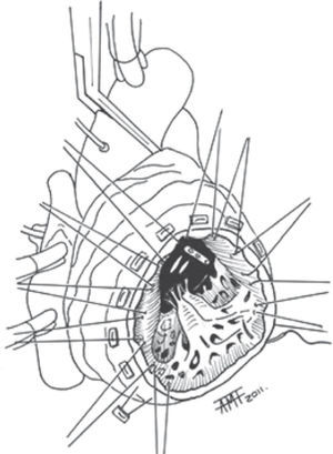 Reconstrucción ventricular. Paso de suturas después de la resección.